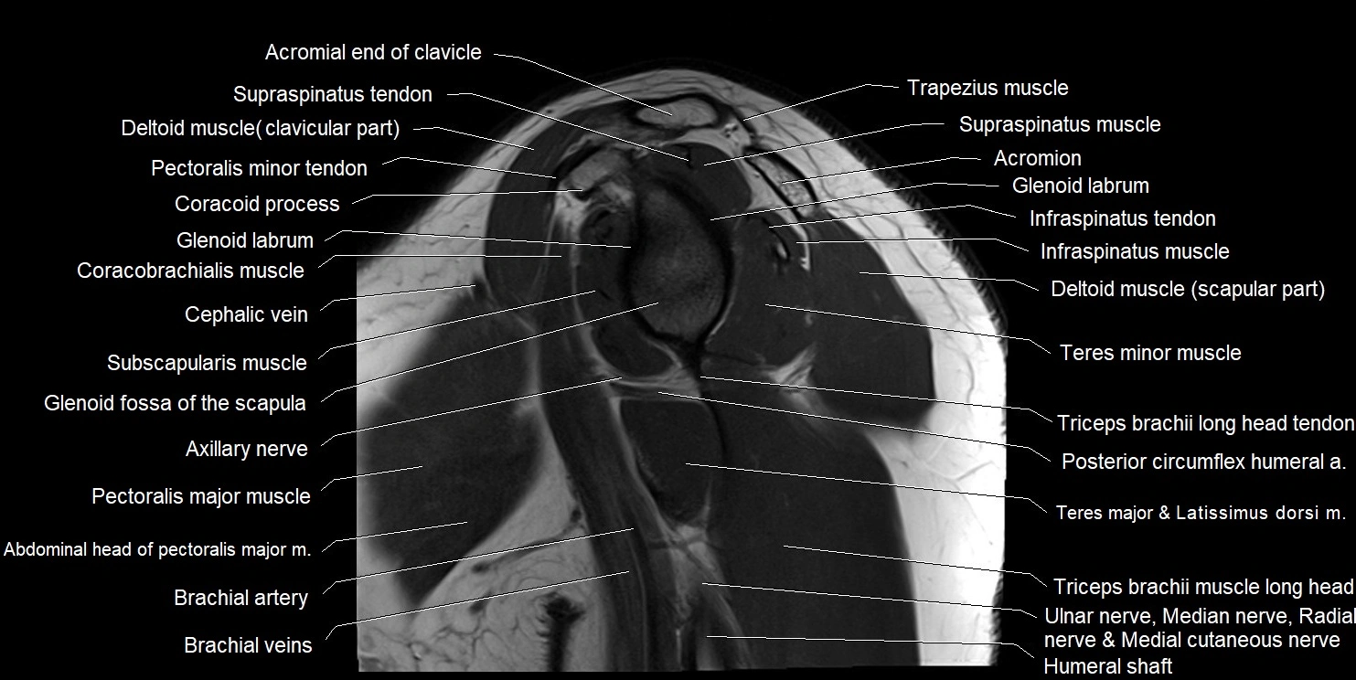 mri shoulder sagittal cross sectional anatomy image 7.webp